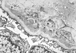 type I membranoproliferative glomerulonephritis type I membranoproliferative glomerulonephritis